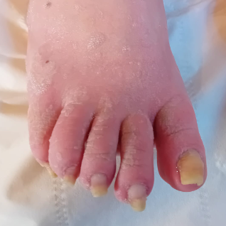 Athletes Foot