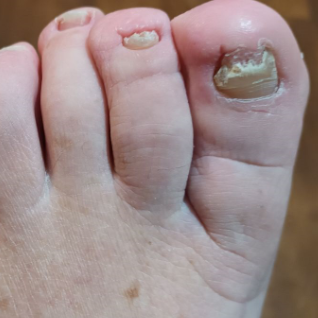 Damaged Nails