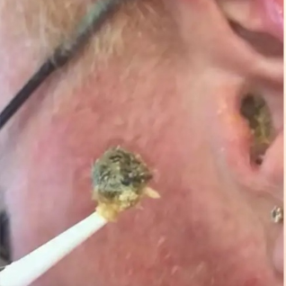 Ear Wax