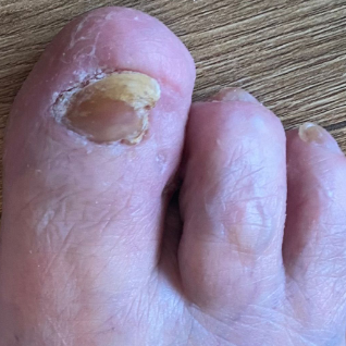 Fungal Nail Infection