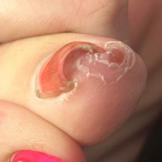 Ingrown Toenail