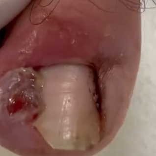 Infected Ingrown Toenail
